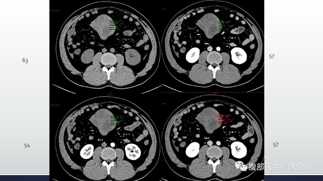 影像PPT - 【病例】肠系膜侵袭性纤维瘤病1例CT-13