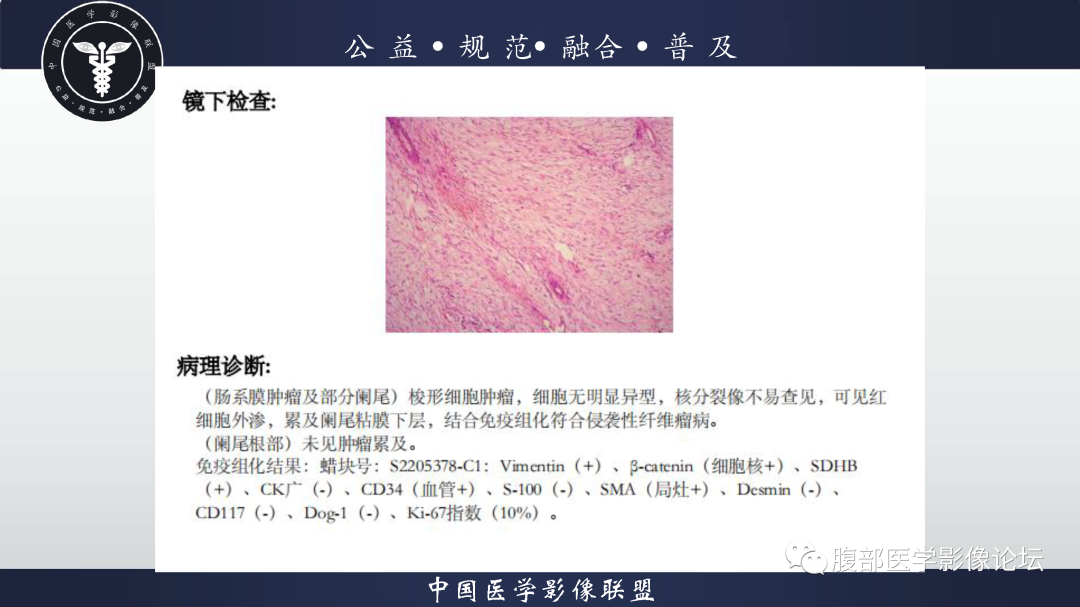 影像PPT - 【病例】肠系膜侵袭性纤维瘤病1例CT-14