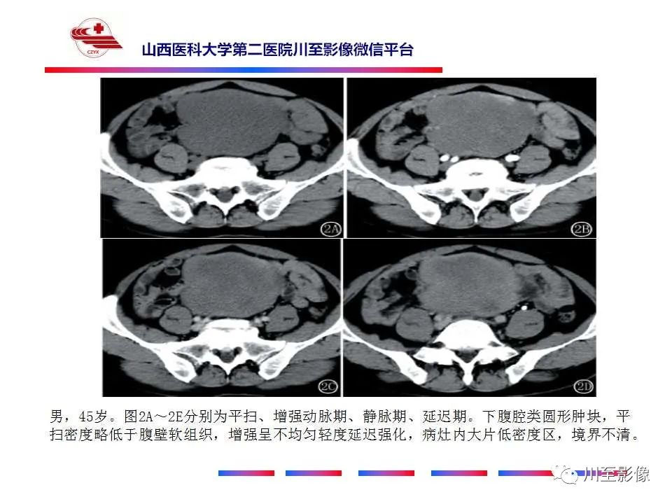 影像PPT - 【病例】肠系膜侵袭性纤维瘤病1例CT-25