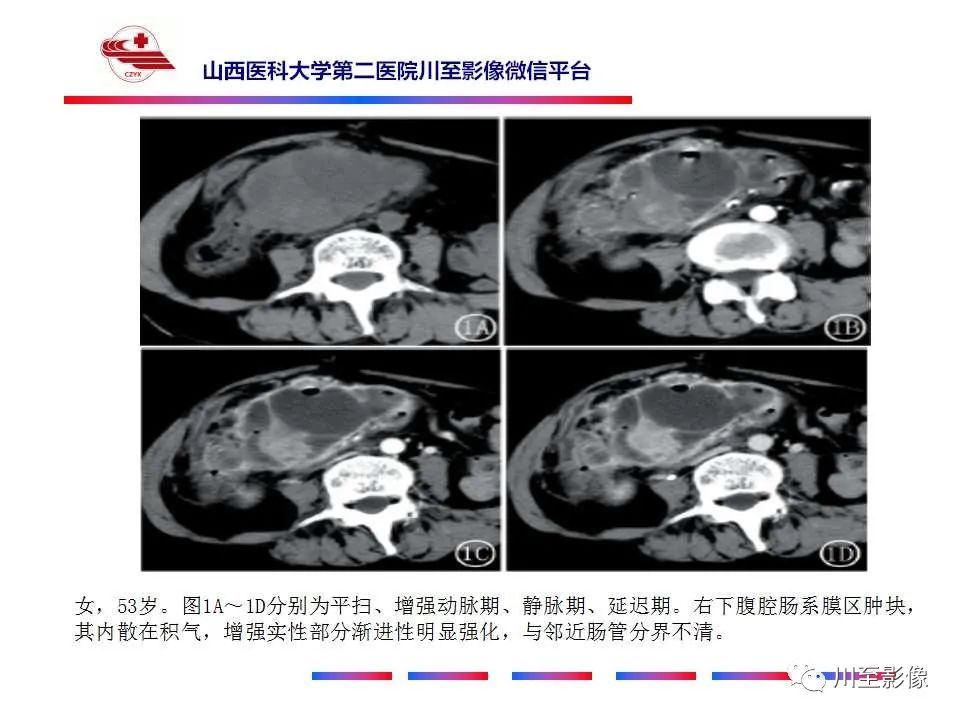 影像PPT - 【病例】肠系膜侵袭性纤维瘤病1例CT-26