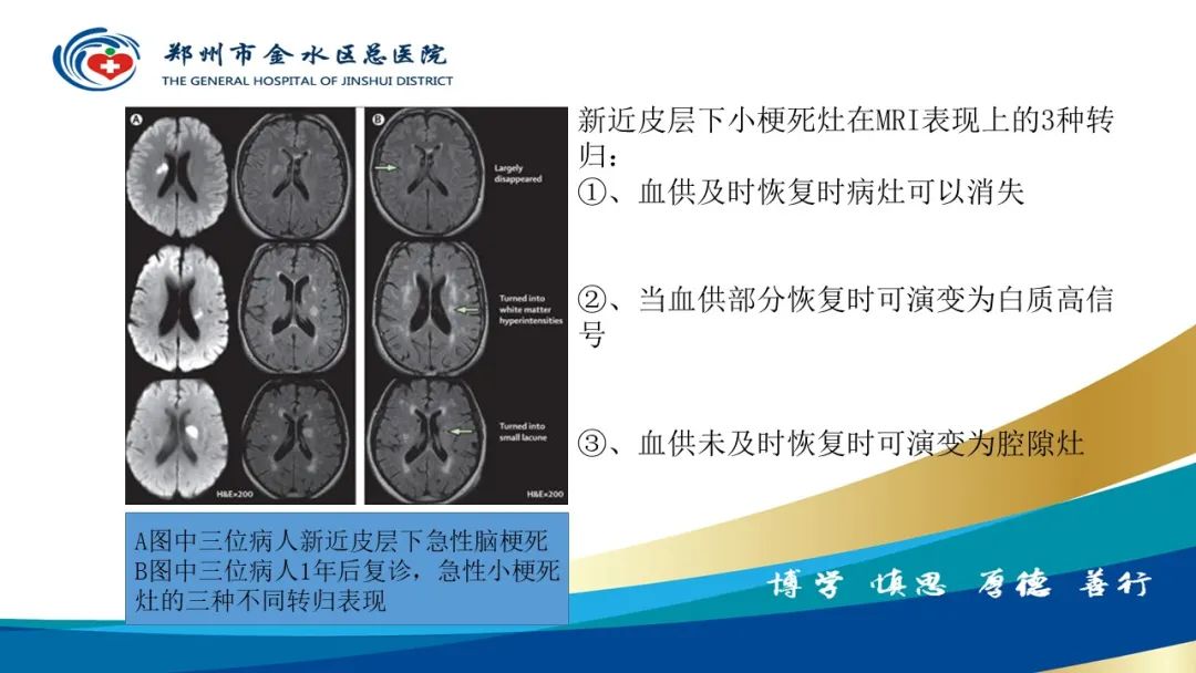 影像PPT - 【PPT】脑小血管病的影像诊断及鉴别诊断-9
