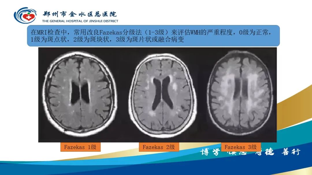 影像PPT - 【PPT】脑小血管病的影像诊断及鉴别诊断-15