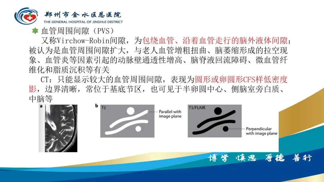 影像PPT - 【PPT】脑小血管病的影像诊断及鉴别诊断-16