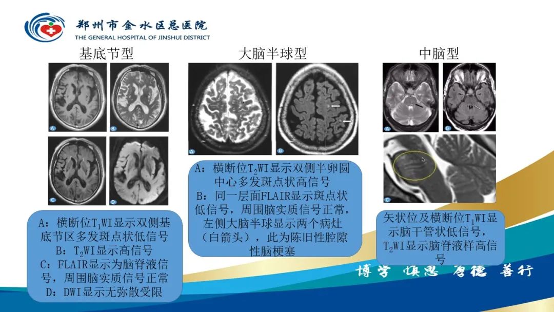 影像PPT - 【PPT】脑小血管病的影像诊断及鉴别诊断-18