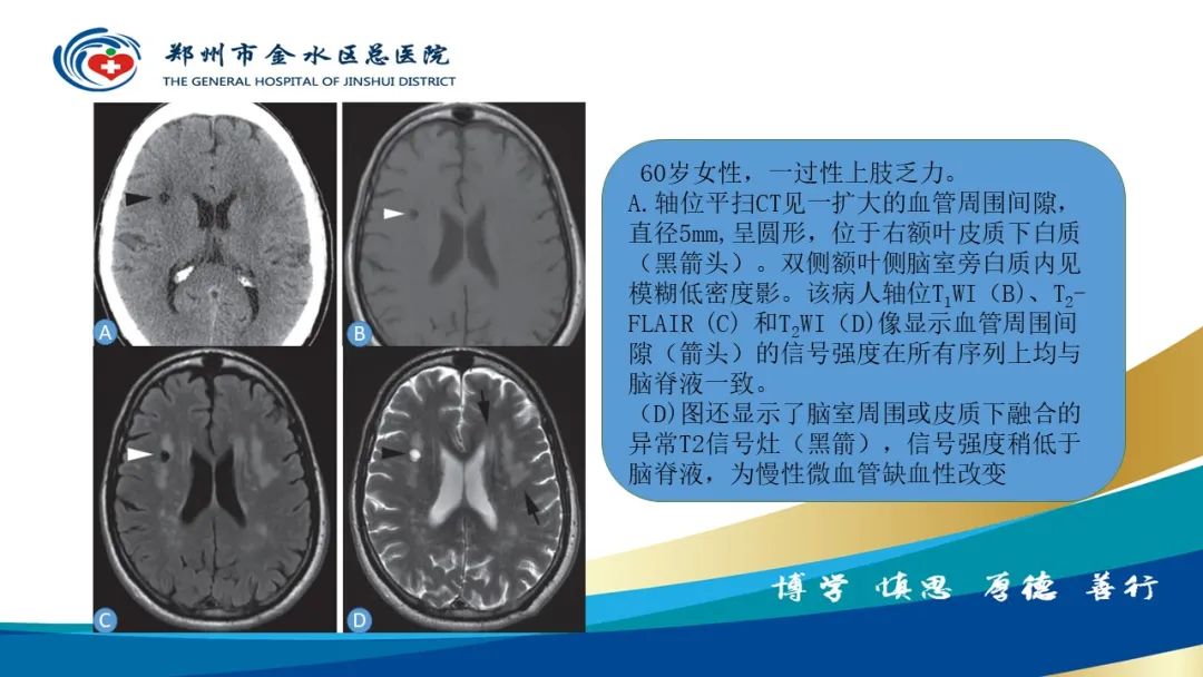 影像PPT - 【PPT】脑小血管病的影像诊断及鉴别诊断-19