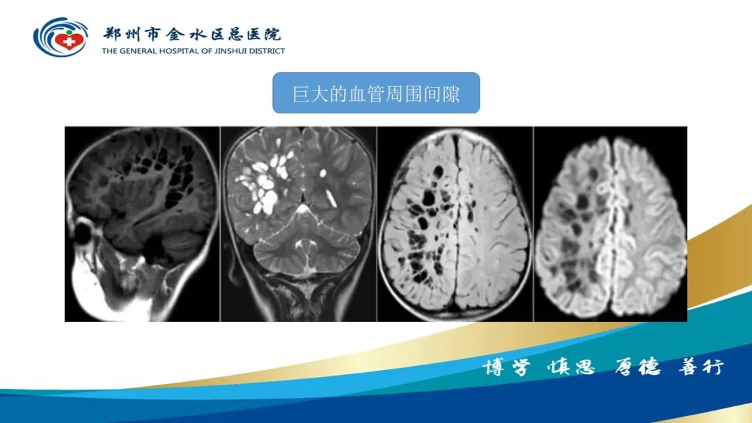 影像PPT - 【PPT】脑小血管病的影像诊断及鉴别诊断-20