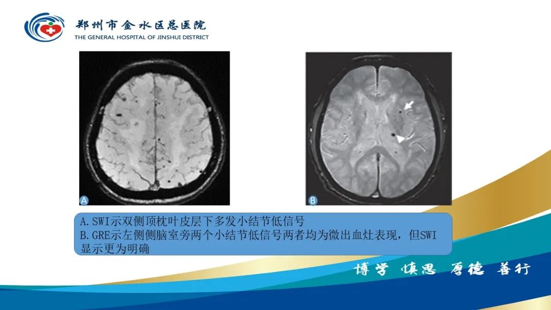 影像PPT - 【PPT】脑小血管病的影像诊断及鉴别诊断-23