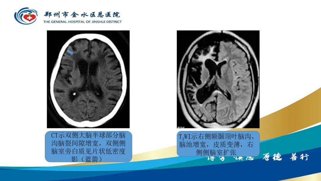 影像PPT - 【PPT】脑小血管病的影像诊断及鉴别诊断-25
