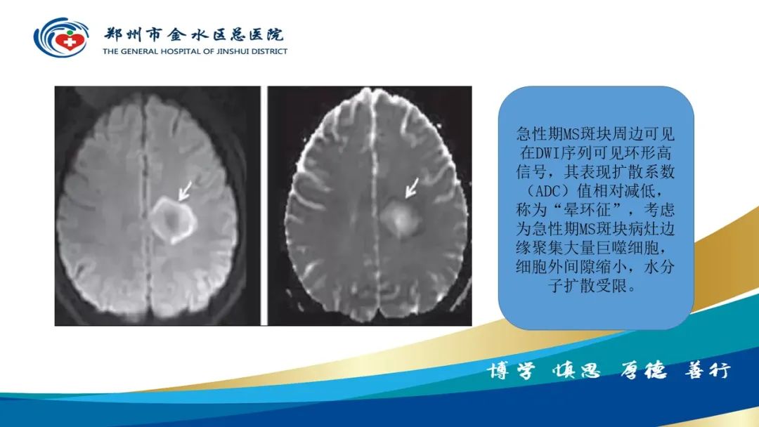 影像PPT - 【PPT】脑小血管病的影像诊断及鉴别诊断-28