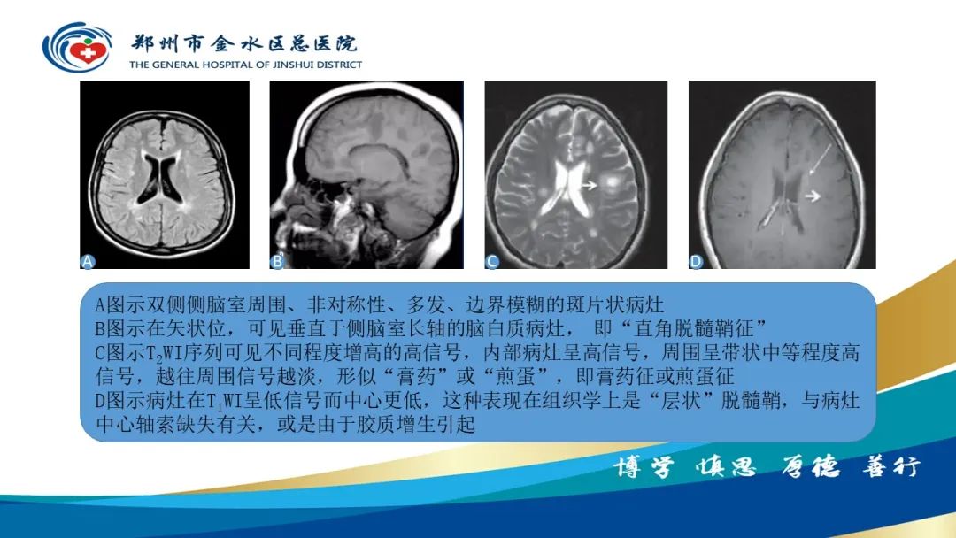 影像PPT - 【PPT】脑小血管病的影像诊断及鉴别诊断-27