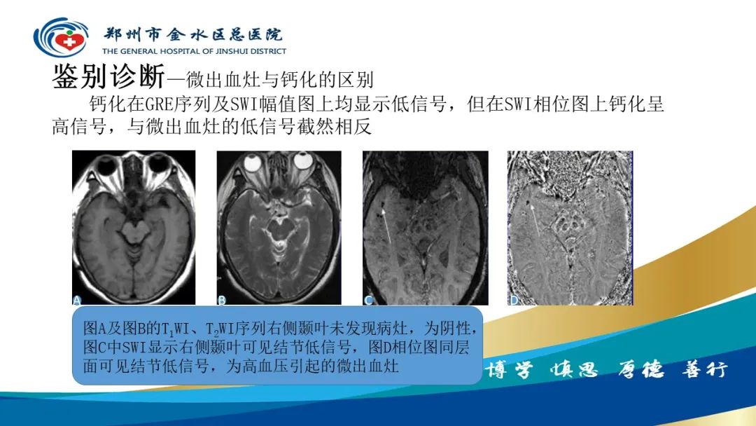 影像PPT - 【PPT】脑小血管病的影像诊断及鉴别诊断-29