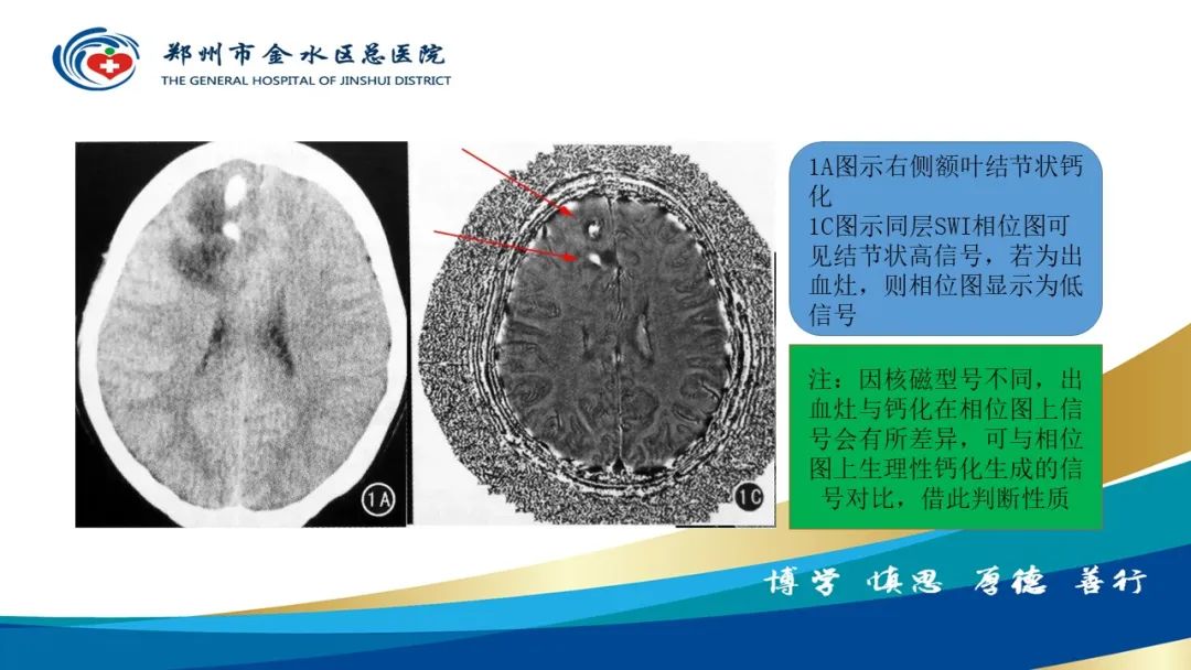 影像PPT - 【PPT】脑小血管病的影像诊断及鉴别诊断-30