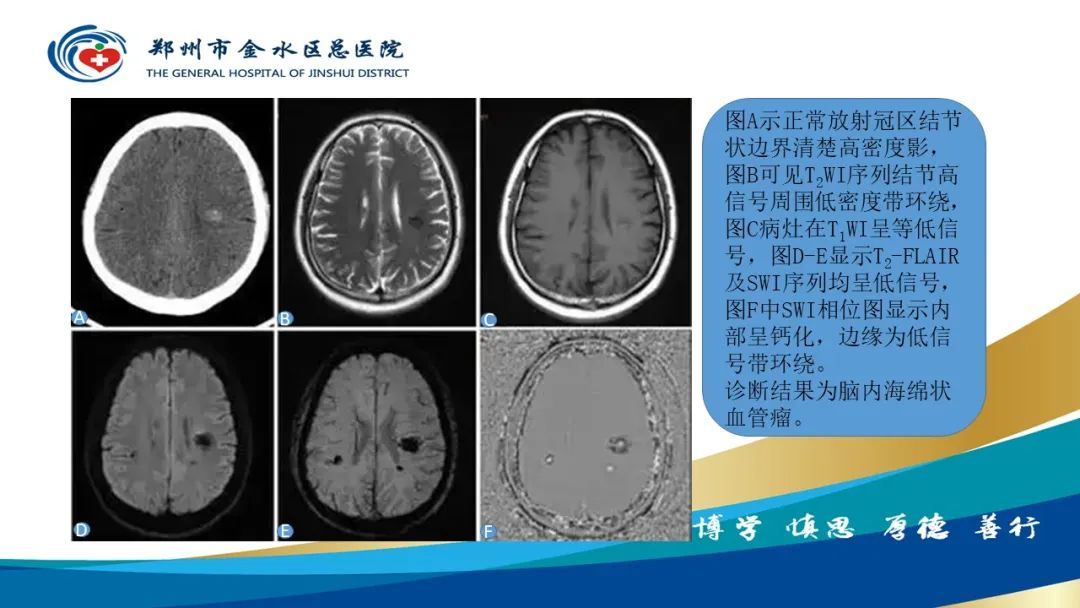 影像PPT - 【PPT】脑小血管病的影像诊断及鉴别诊断-32