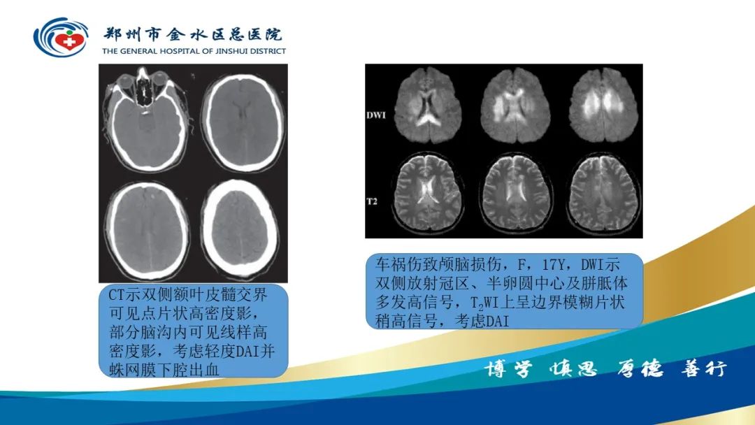 影像PPT - 【PPT】脑小血管病的影像诊断及鉴别诊断-35