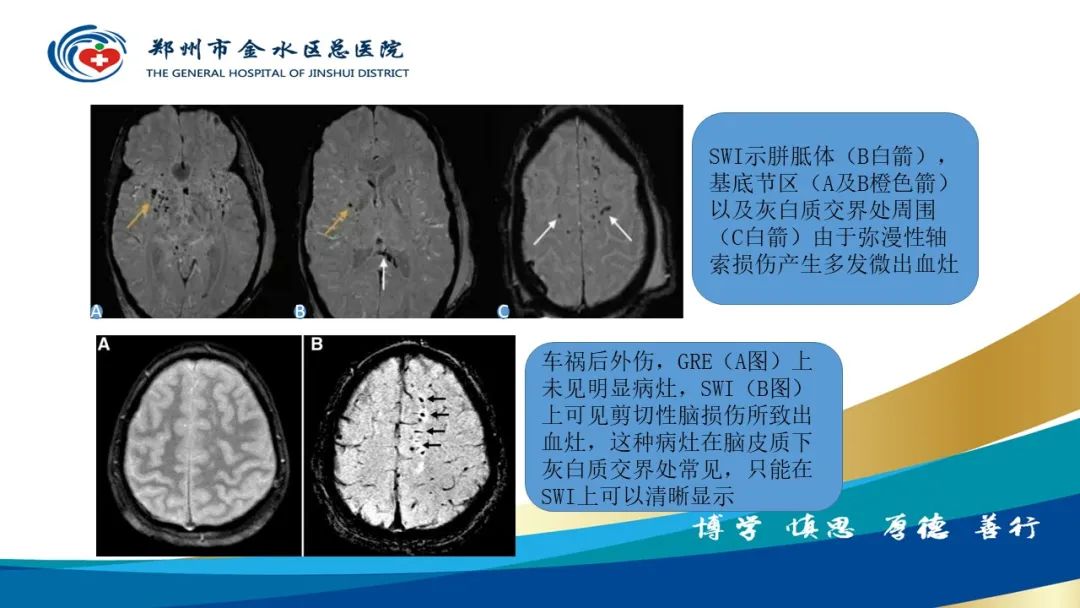 影像PPT - 【PPT】脑小血管病的影像诊断及鉴别诊断-36