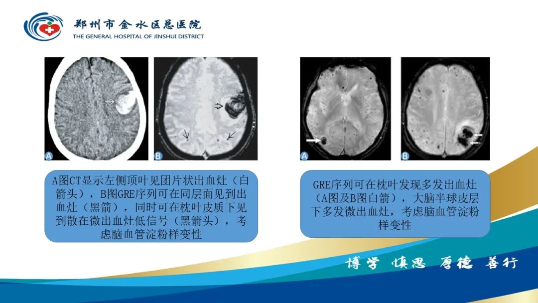 影像PPT - 【PPT】脑小血管病的影像诊断及鉴别诊断-38
