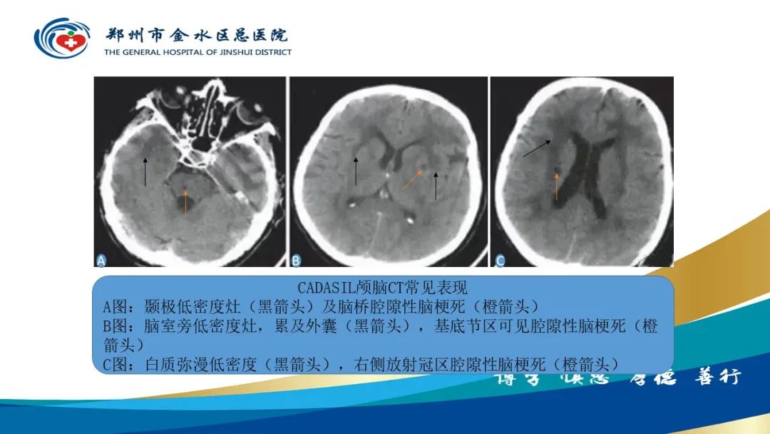 影像PPT - 【PPT】脑小血管病的影像诊断及鉴别诊断-40