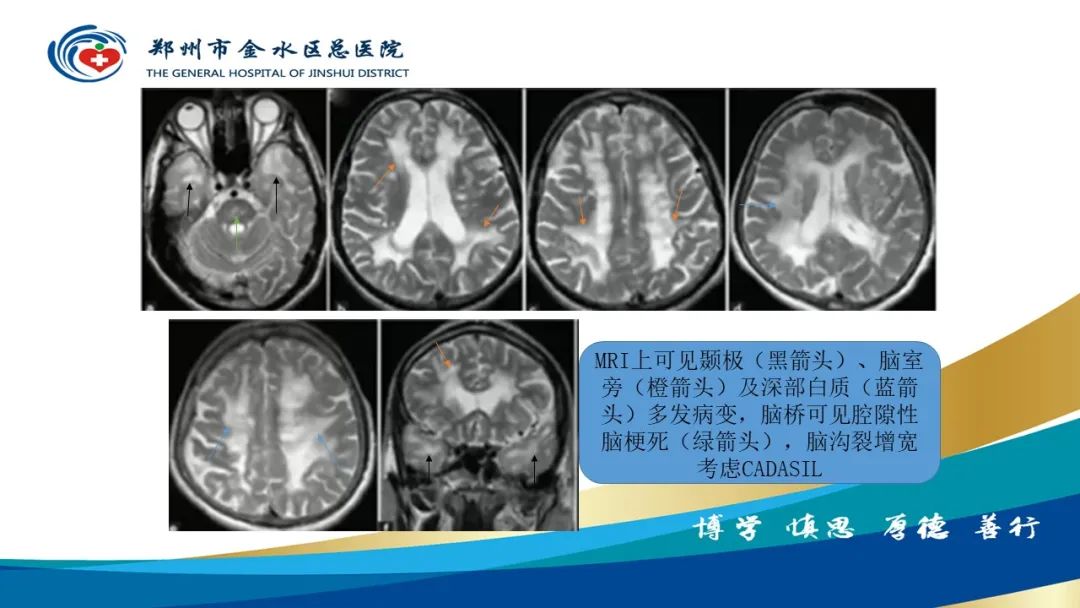 影像PPT - 【PPT】脑小血管病的影像诊断及鉴别诊断-41