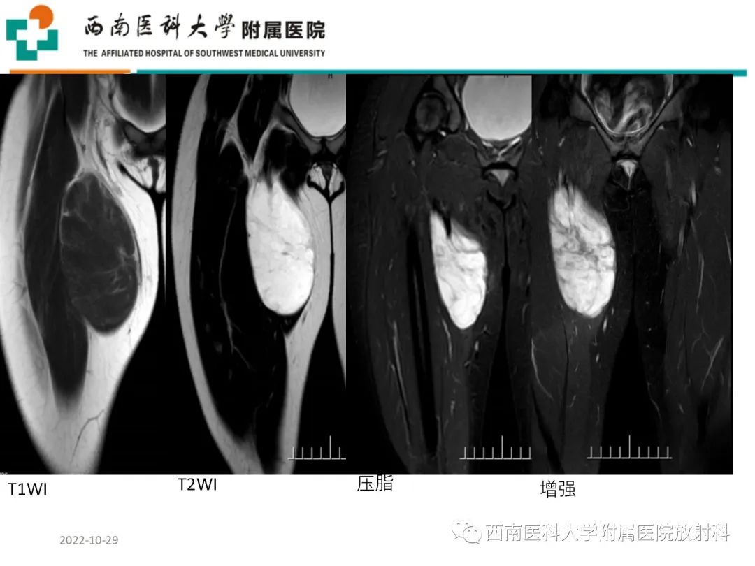 影像PPT - 【病例】大腿脂肪母细胞瘤1例MR影像诊断-2