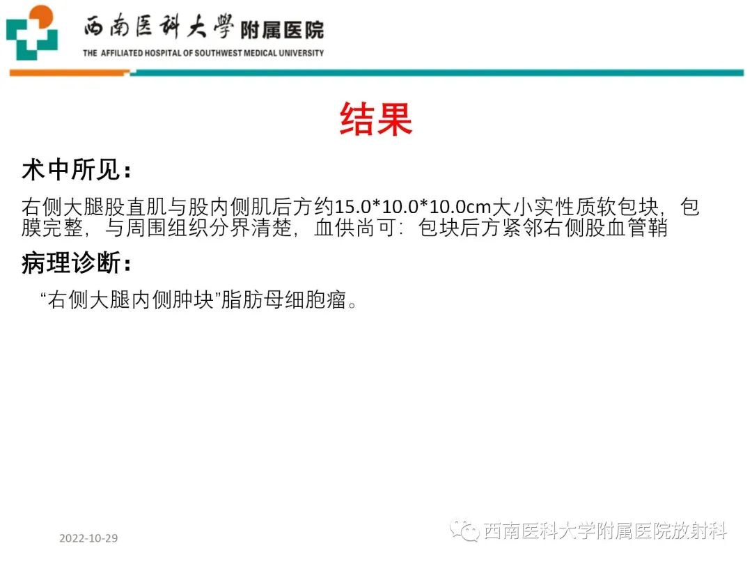 影像PPT - 【病例】大腿脂肪母细胞瘤1例MR影像诊断-4