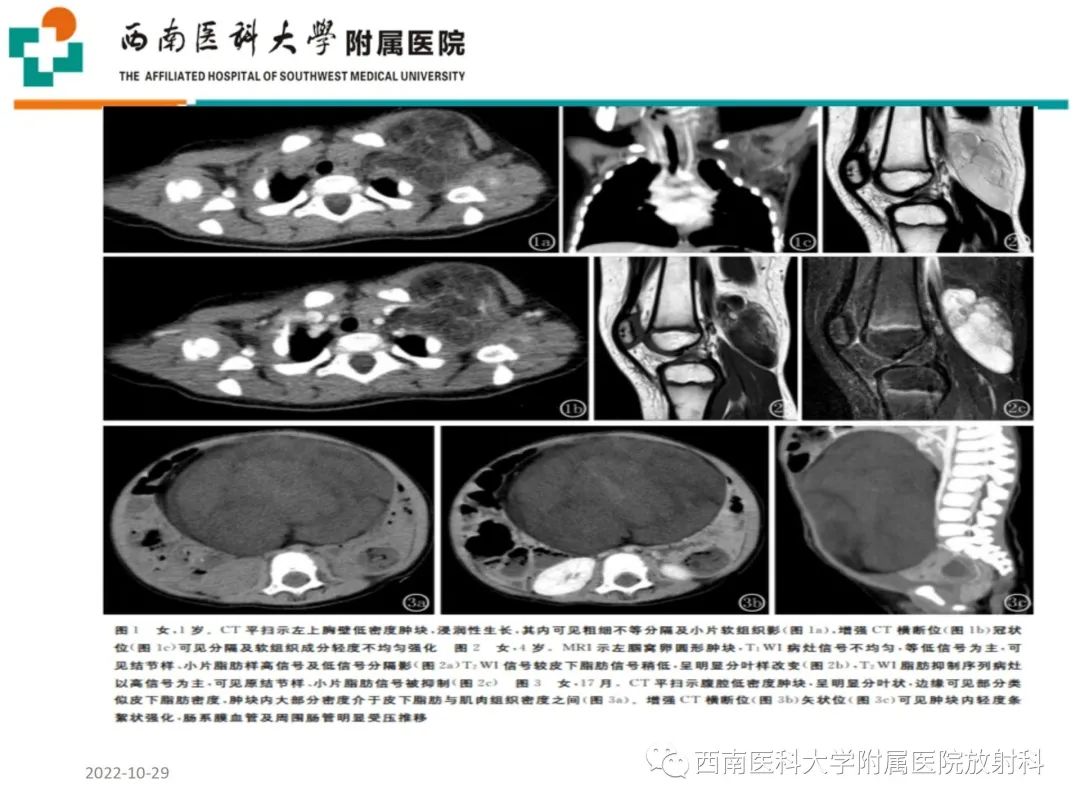 影像PPT - 【病例】大腿脂肪母细胞瘤1例MR影像诊断-9