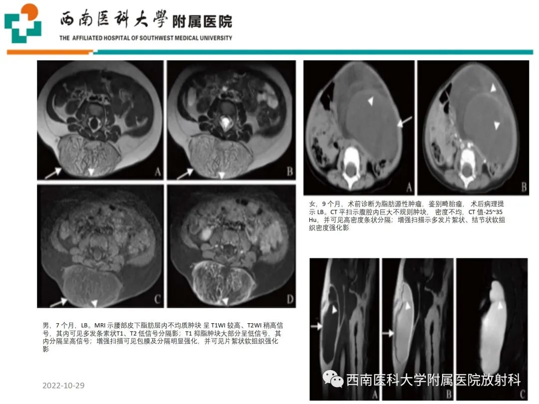 影像PPT - 【病例】大腿脂肪母细胞瘤1例MR影像诊断-10