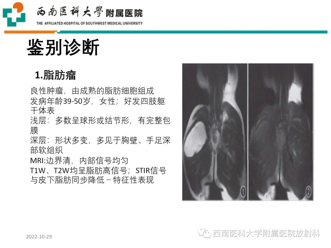 影像PPT - 【病例】大腿脂肪母细胞瘤1例MR影像诊断-11