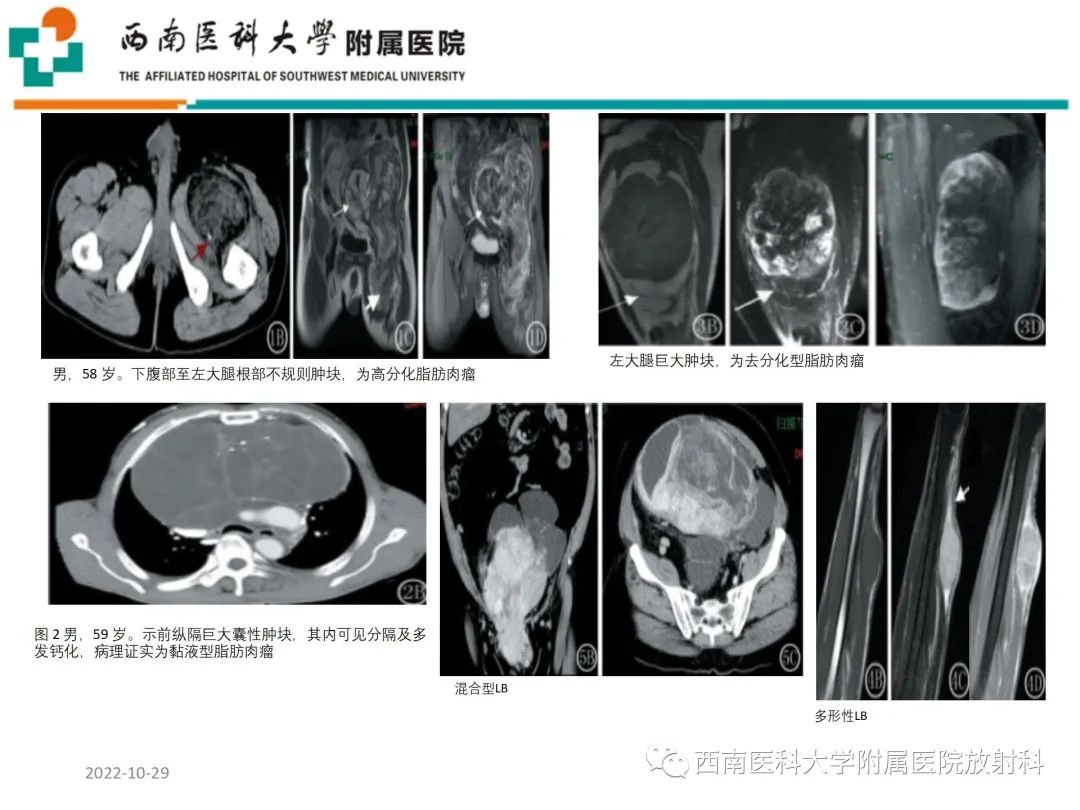 影像PPT - 【病例】大腿脂肪母细胞瘤1例MR影像诊断-15