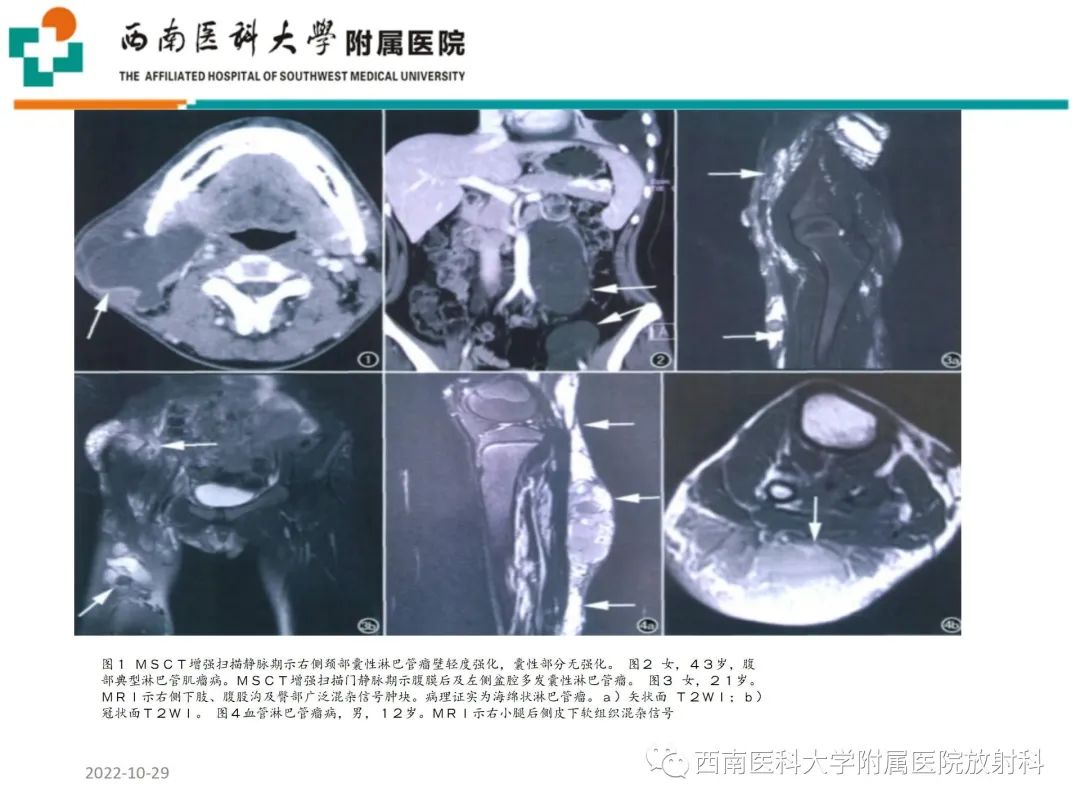 影像PPT - 【病例】大腿脂肪母细胞瘤1例MR影像诊断-18