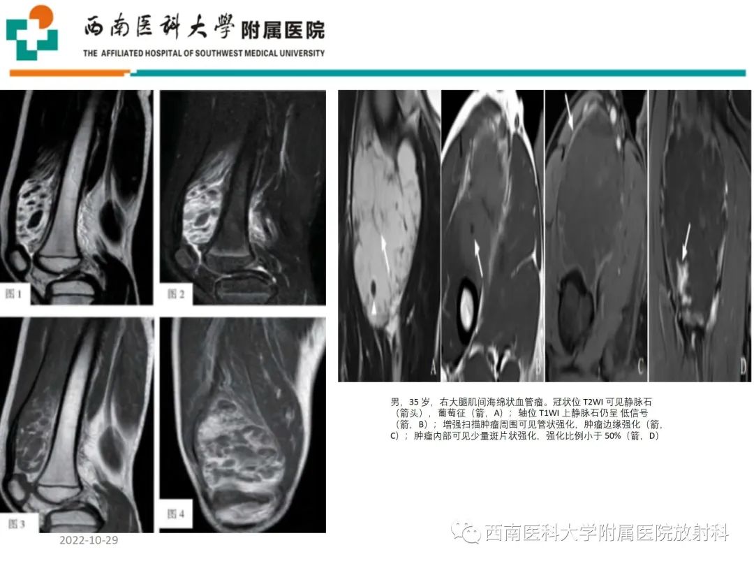 影像PPT - 【病例】大腿脂肪母细胞瘤1例MR影像诊断-20