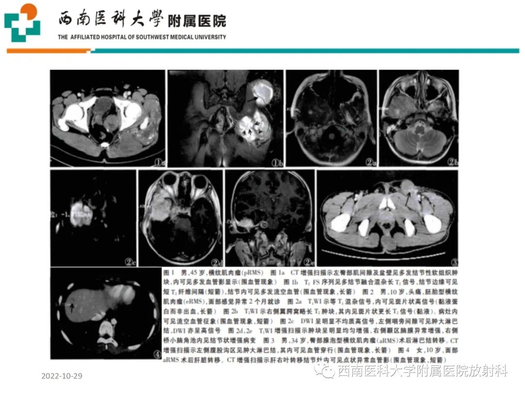 影像PPT - 【病例】大腿脂肪母细胞瘤1例MR影像诊断-23
