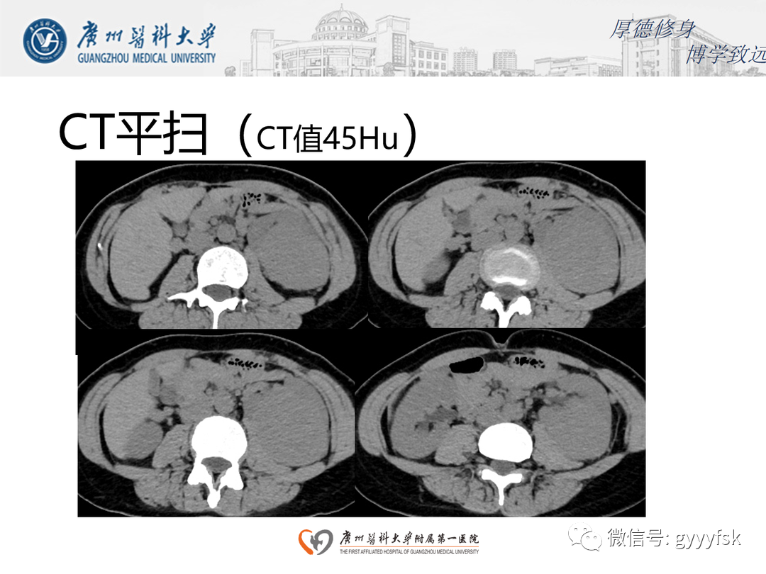 影像PPT - 【PPT】肾脏嫌色细胞癌-5