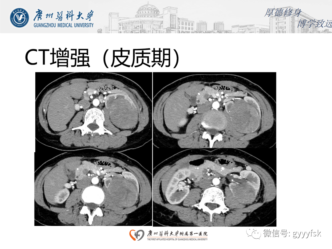 影像PPT - 【PPT】肾脏嫌色细胞癌-6