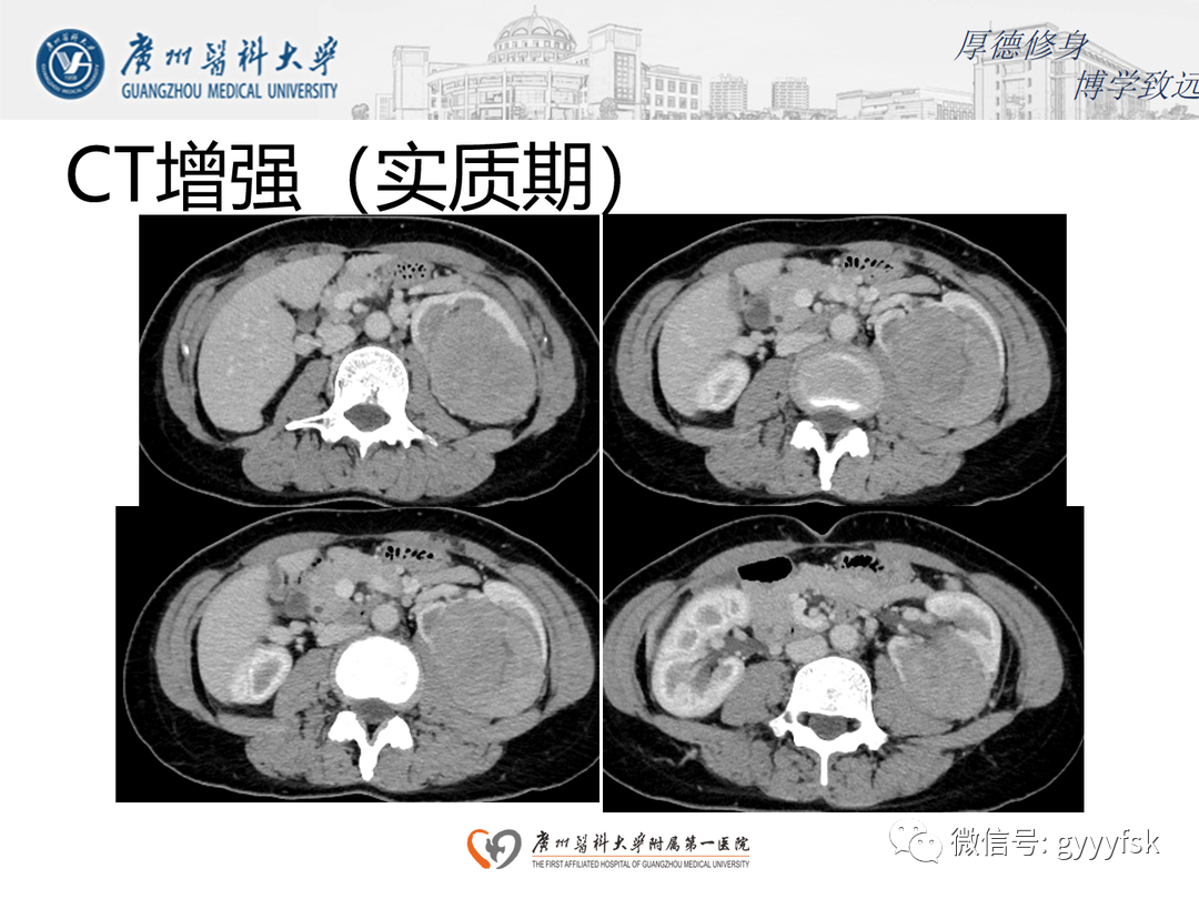 影像PPT - 【PPT】肾脏嫌色细胞癌-7