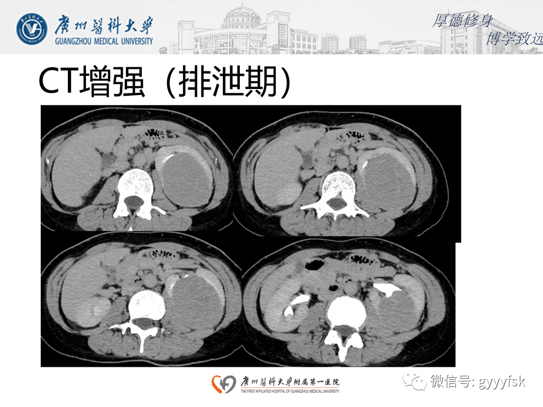 影像PPT - 【PPT】肾脏嫌色细胞癌-8