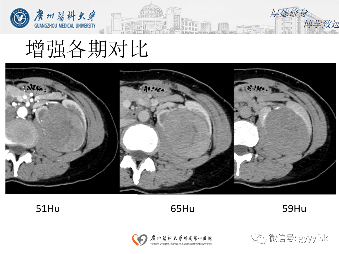 影像PPT - 【PPT】肾脏嫌色细胞癌-9
