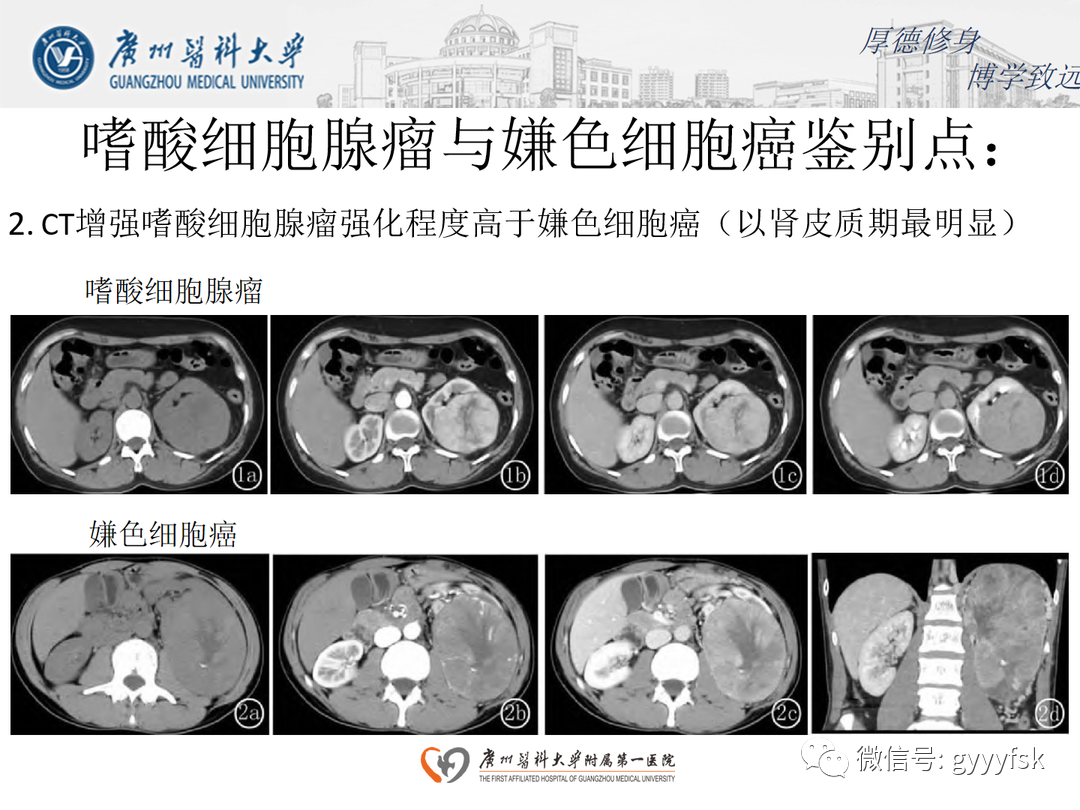 影像PPT - 【PPT】肾脏嫌色细胞癌-18