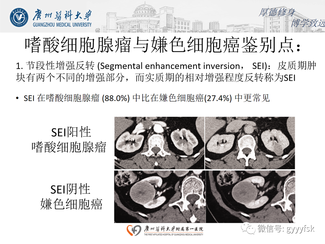影像PPT - 【PPT】肾脏嫌色细胞癌-17