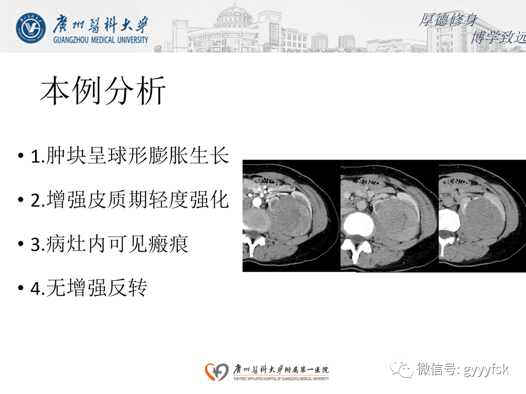 影像PPT - 【PPT】肾脏嫌色细胞癌-19