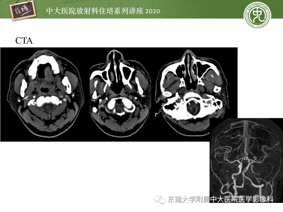 影像PPT - 【PPT】颈动脉夹层及夹层动脉瘤的影像诊断及评估-4