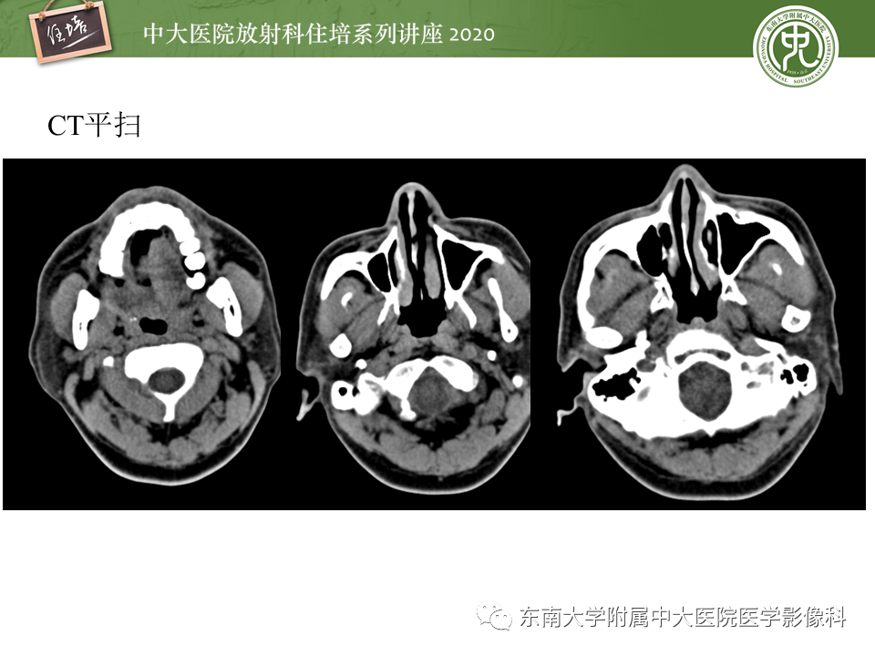 影像PPT - 【PPT】颈动脉夹层及夹层动脉瘤的影像诊断及评估-3