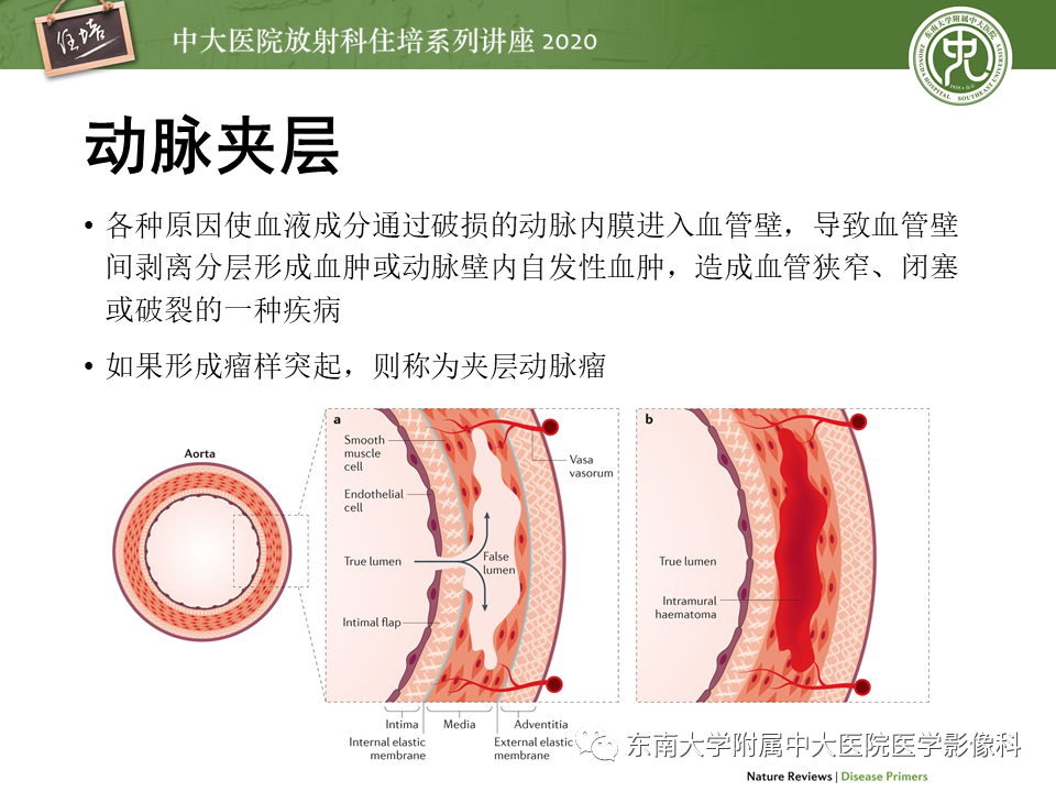 影像PPT - 【PPT】颈动脉夹层及夹层动脉瘤的影像诊断及评估-6