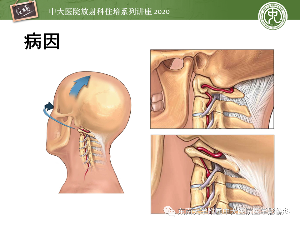 影像PPT - 【PPT】颈动脉夹层及夹层动脉瘤的影像诊断及评估-9