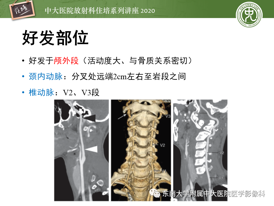 影像PPT - 【PPT】颈动脉夹层及夹层动脉瘤的影像诊断及评估-11