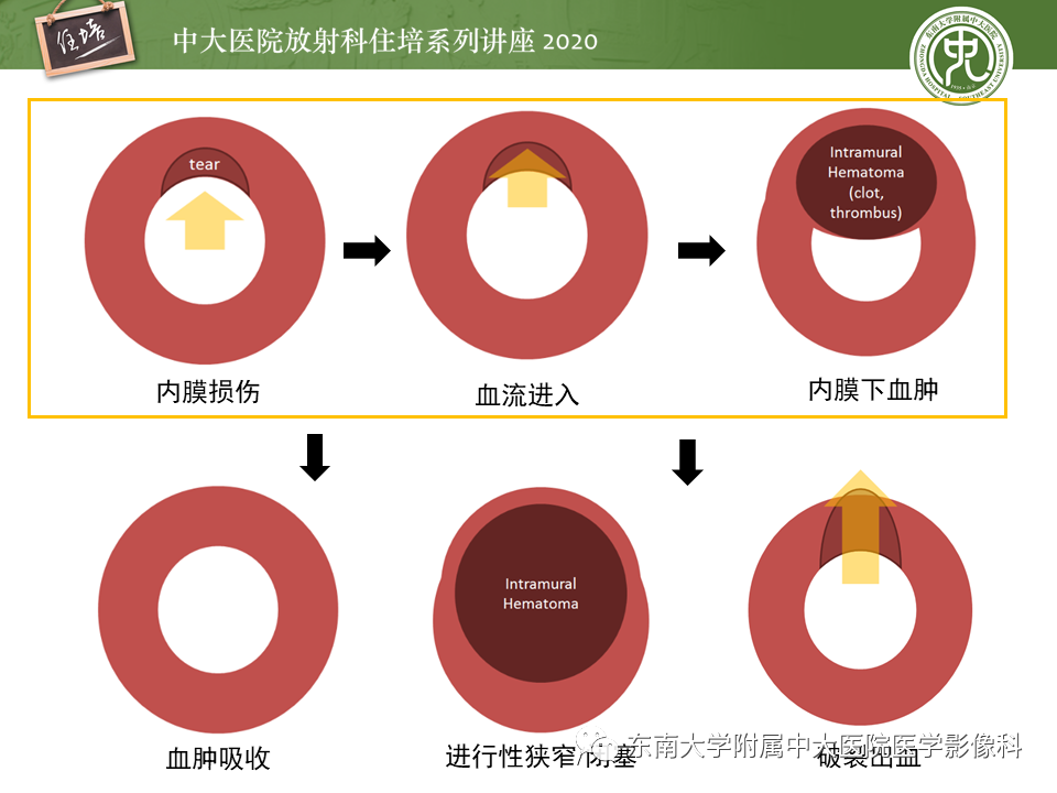 影像PPT - 【PPT】颈动脉夹层及夹层动脉瘤的影像诊断及评估-13