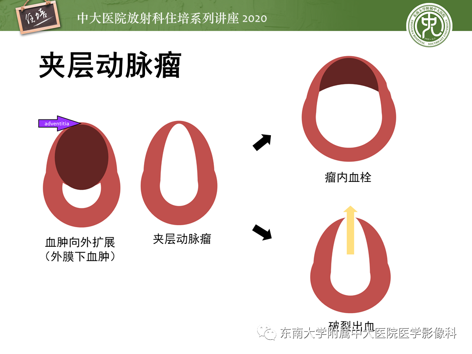 影像PPT - 【PPT】颈动脉夹层及夹层动脉瘤的影像诊断及评估-14