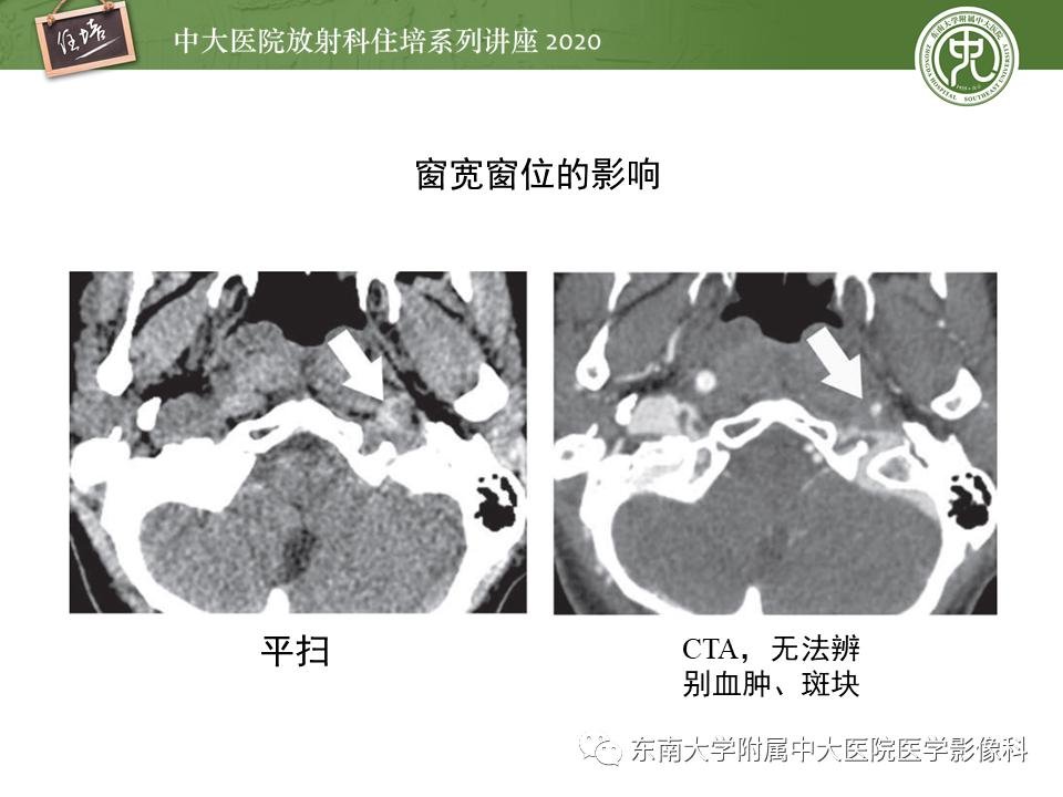 影像PPT - 【PPT】颈动脉夹层及夹层动脉瘤的影像诊断及评估-18