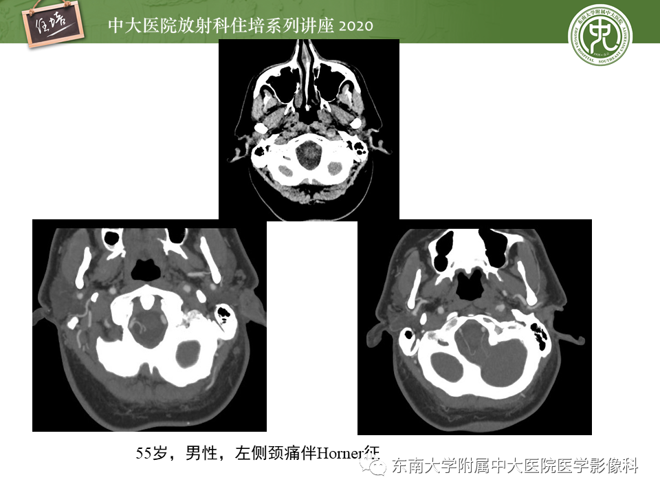 影像PPT - 【PPT】颈动脉夹层及夹层动脉瘤的影像诊断及评估-19