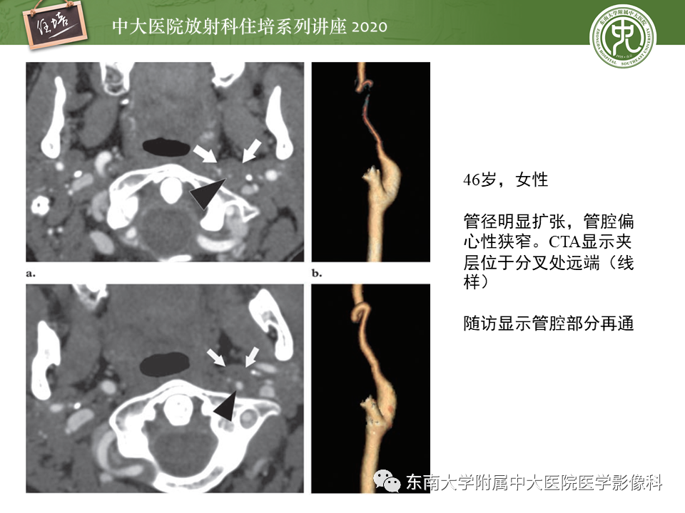 影像PPT - 【PPT】颈动脉夹层及夹层动脉瘤的影像诊断及评估-21