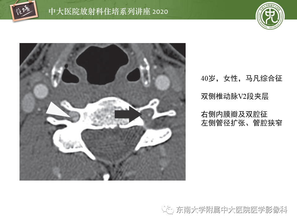 影像PPT - 【PPT】颈动脉夹层及夹层动脉瘤的影像诊断及评估-22